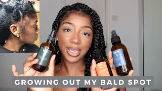 I Gave Myself A Bald Spot And Now I&#39;m Growing It Back -  Planted Review