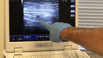 EVLT R GSV with CATHETER DIRECTED ECA