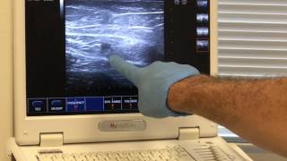 EVLT R GSV with CATHETER DIRECTED ECA