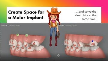 Invisalign ClinCheck - Planning for implant and solving deep bite
