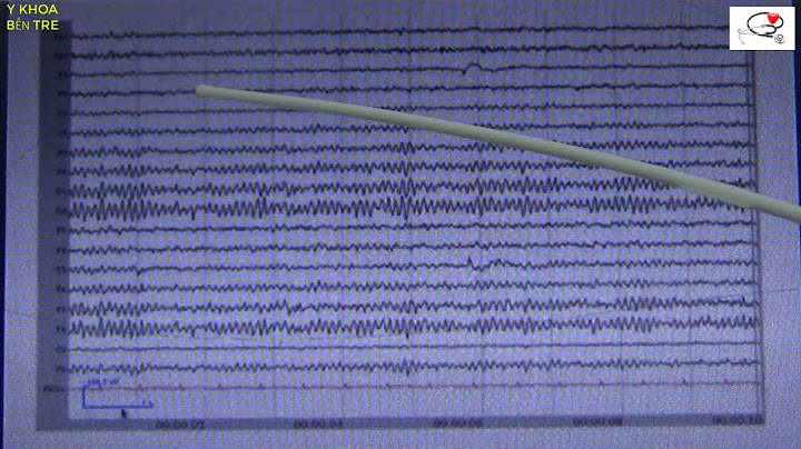 Hướng dẫn cách đọc điện não đồ năm 2024