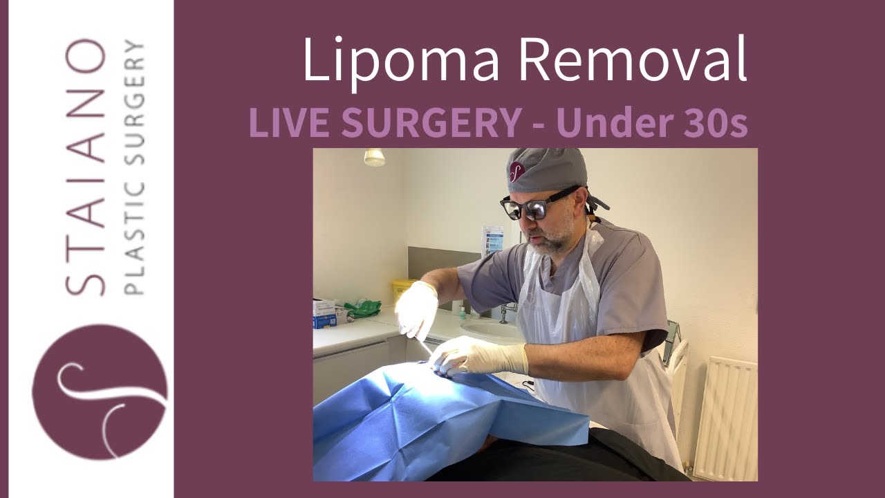 [LIVE SURGERY] Lipoma Removal - Under 30s