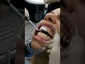 Dental Implant Procedure Step by Step 🦷 Missing Tooth Replacement#dentalcare #dentist #teethdecay
