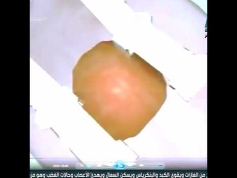 الجديد في علاج العيوب الخلقية في الاطفال هايبرد دكتور حسام فتحى على