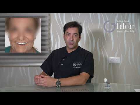 Que es una cirugía guiada de implantes dentales