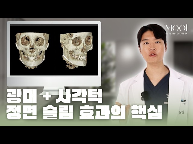 윤곽수술 성공 기준? 정면보다 '이 각도'를 보세요|무이성형외과 #얼굴형 #옆광대 #사각턱