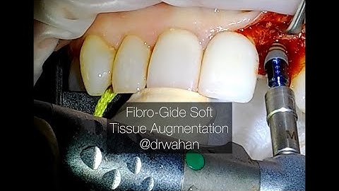 Fibro-Gide Soft Tissue Augmentation Tip with Dental Implant Placement