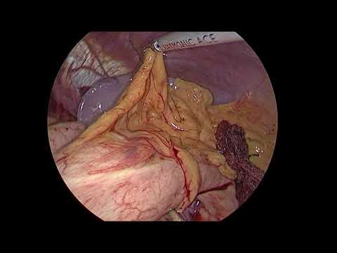 Heller's cardiomyotomy with Dor fundoplication for achalasia cardia