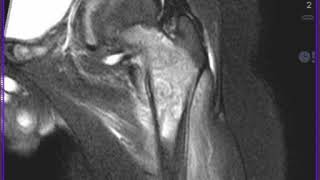 Msk Tumor C4 Acute Osteomyelitis C