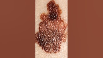 A Farmer 👨‍🌾 Removed His Own Skin Cancer With A Pocket Knife