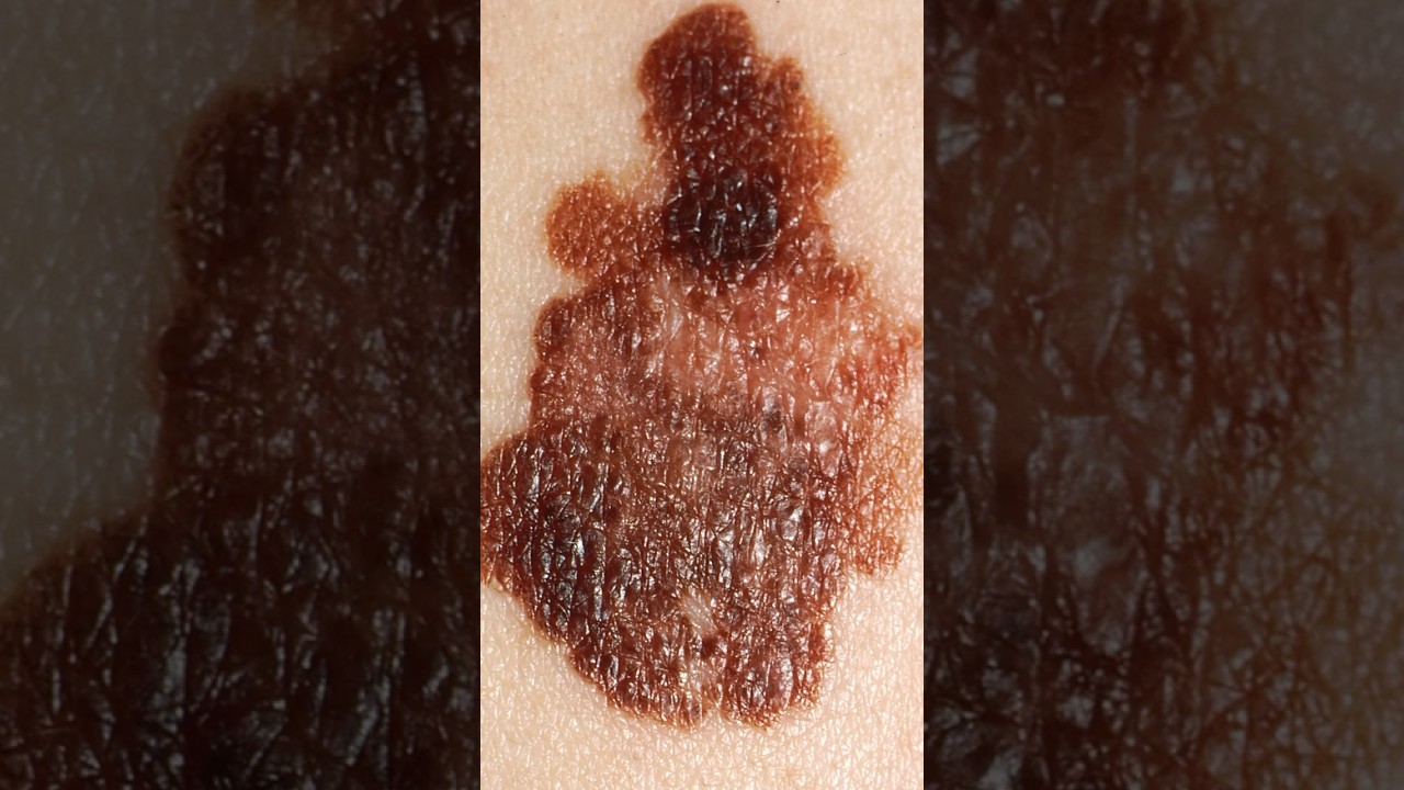 A Farmer ?‍? Removed His Own Skin Cancer With A Pocket Knife