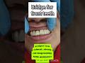 Front teeth missing होने पर Bridging restores your smile, confidence and chewing ability-NO surgery.