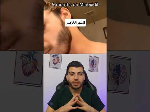 تأثير بخاخ المينوكسيديل ع الذقن الذقن حلاقة الذقن مينوكسديل ثعلبة الشعر حلاقة رجالية د مصعب حسوا