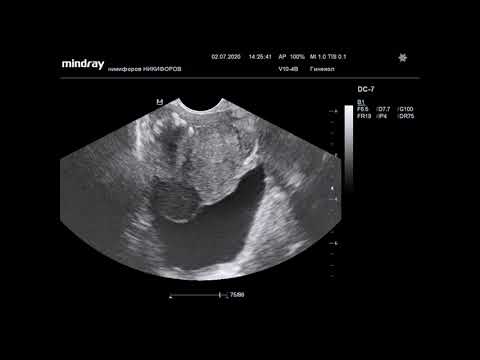 Ультразвуковая диагностика. Доктор Иогансен. Видеопримеры. Выпуск 20. Рак предстательной железы.