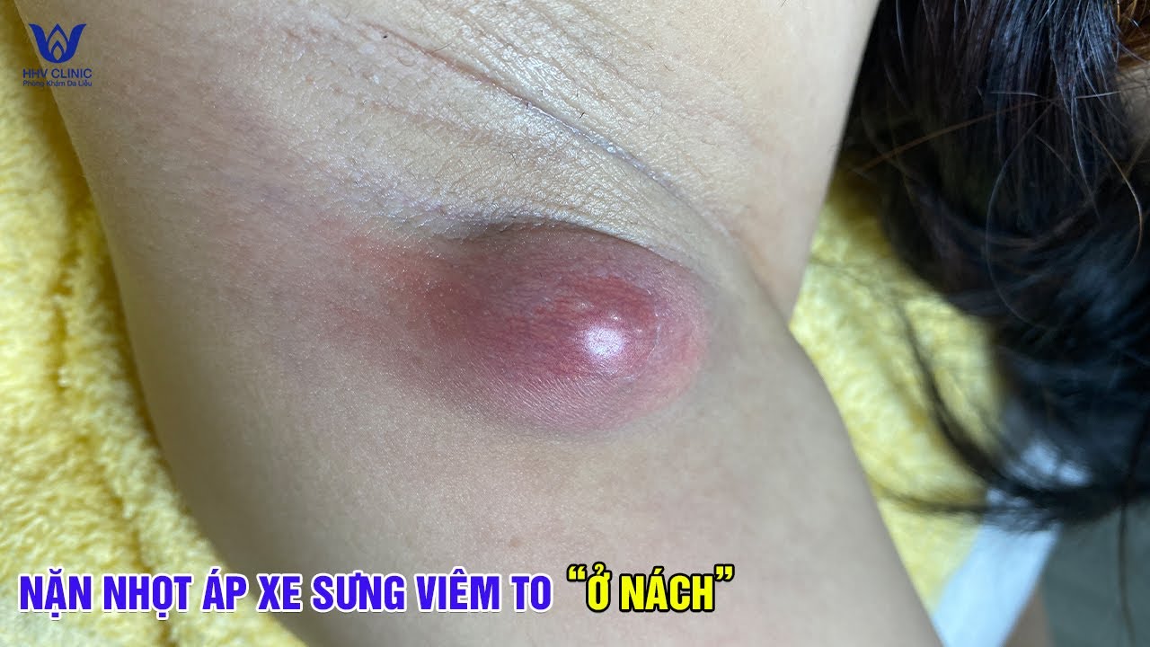 Tổng hợp những ca nặn mụn nhọt sưng viêm to ở nách - Tại phòng khám da liễu HHV Clinic.