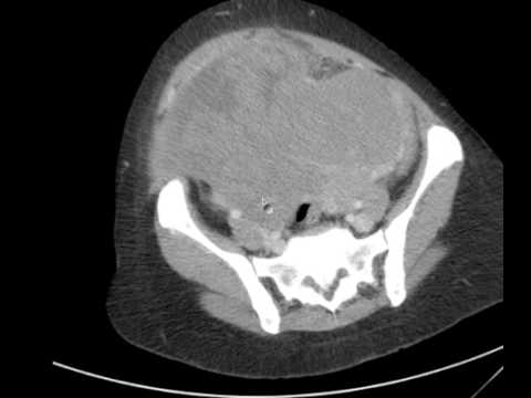 CT Abdomen & Pelvis w HUGE Fibroid Uterus DISCUSSION by a Radiologist