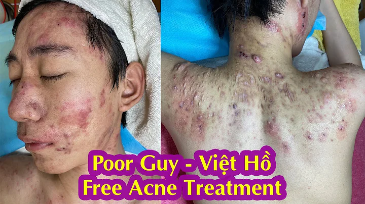Poor Guy I Cystic Acne TreatmentI iu tr mn min ph ...