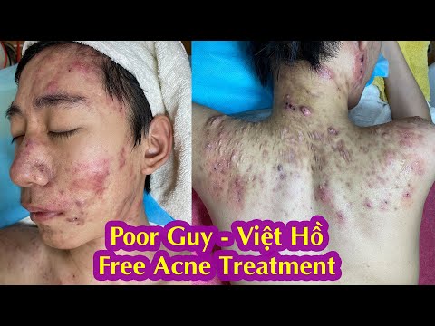 Poor Guy I Cystic Acne TreatmentI Điều trị mụn miễn phí Hiền Vân Spa I Huỳnh Việt Hồ sau 2 buổi I508