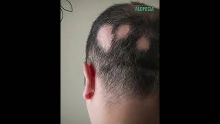 ALOPECIA  الحل النهائي لداء التعلبة