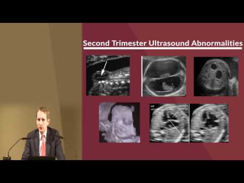 Video: Down Syndrome On Ultrasound