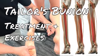 Tailor's Bunion  Treatment & Exercises