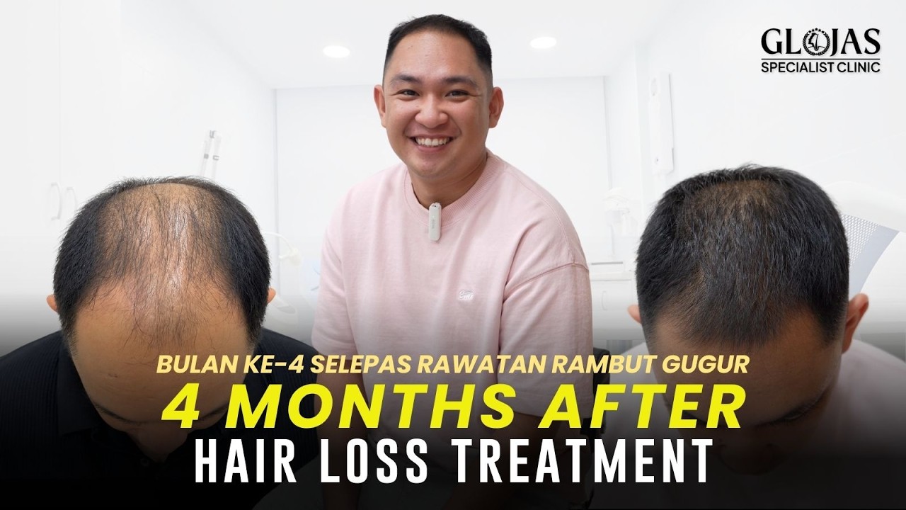 Our Doctors 13 Hair Transplant Malaysia | 4 Months Hair Loss Treatment Results | Patient with Stage 6 Male Pattern
