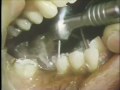 Clinical Procedures in Bridge Construction