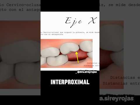 #ejey #ejex #odontologia #implantologíadental #implantesdentales  #carnavalconshortsblanco