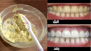 احصل على أسنان بيضاء في 3 دقائق فقط / كيفية تبييض الأسنان في 3 دقائق وازاله الاصفرار
