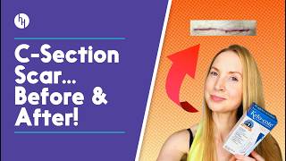 I Used Kelo-Cote On My C-Section Scar For 12 Weeks | Dermatologist Reacts!