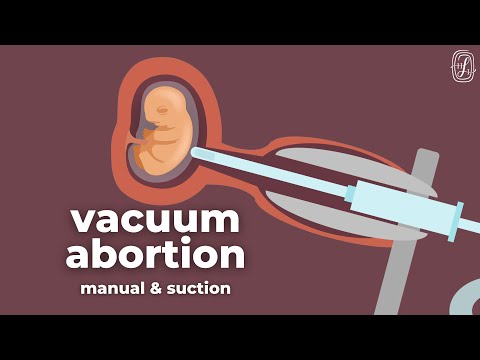 What Is An Evac Procedure