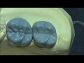 Live wax up - Upper 2nd molar(full)