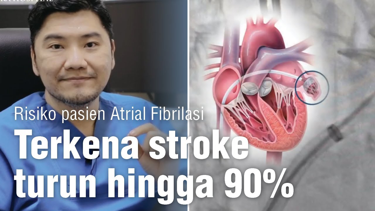 LAA closure. Solusi untuk Atrial Fibrilasi permanen