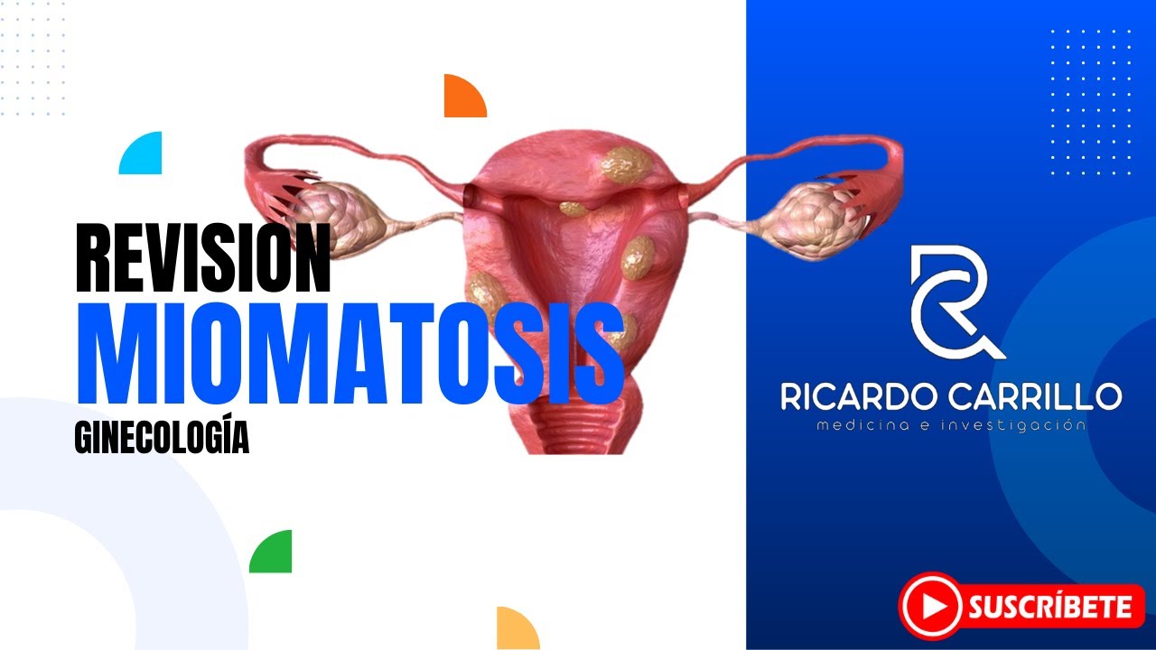 Miomatosis uterina l Ginecología y Obstetricia