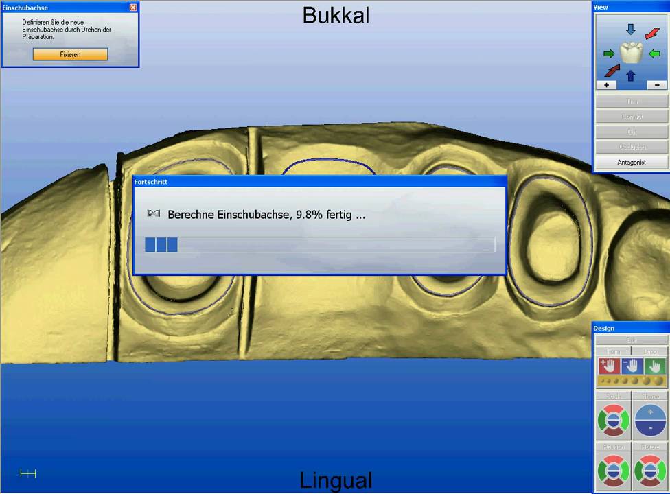 CEREC - CAD/CAM Bridgework - Dental Bridge - YouTube