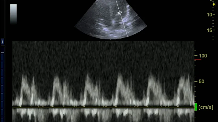 Acquiring the Mitral Inflow View with Pulse Wave Doppler for Diastolic Dysfunction Evaluation
