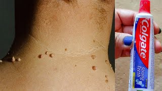 तिल और मस्से को जड़ से खत्म करने का सबसे अच्छा उपाय Remove Skin Tags Naturally / Get Rid of SkinTags