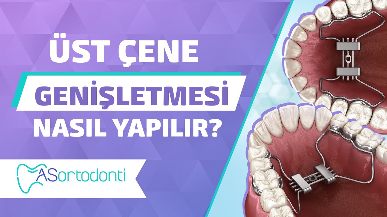 Üst Çene Darlığı Tedavisi, Üst Çene Genişletmesi Nasıl Yapılır? | AS Ortodonti