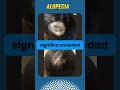 X39 Alopecia