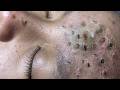 Professional Acne Removal Spa Treatment Compilation