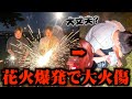 花火してたらりょうくんの花火が爆発して大火傷しましたwwwww