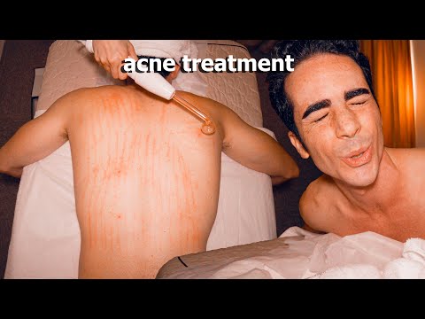ASMR: Ho Provato un Trattamento alla Schiena per la mozione di ACNE e Brufoli con Massaggio!