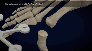 Toe Surgery Animation with First MPJ Hemi Implant screenshot 3