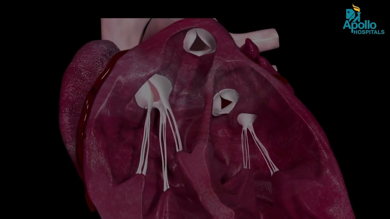What Is Heart Valve Repair? | Doctor Explains Simply