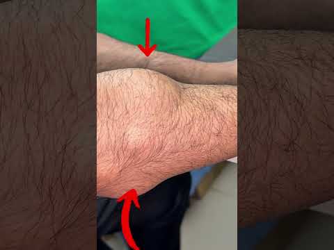হাতের লাইপোমা টিউমার চিকিৎসা
