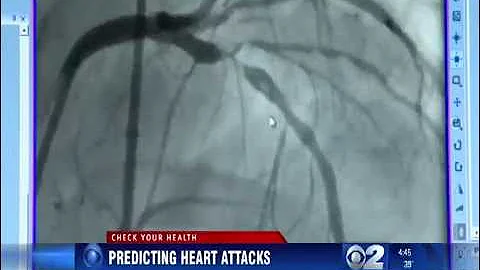 Predicting heart attacks in heart disease patient