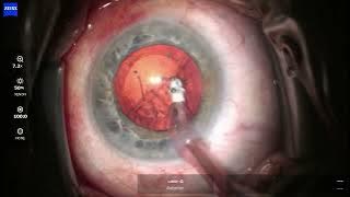 OS 2025 10 30 124025 Phaco Eyhance CTR sever phacodonesis