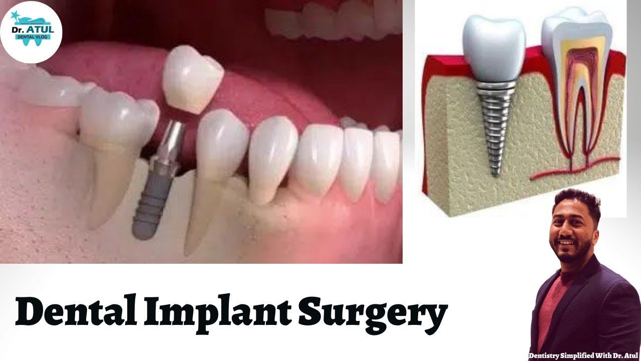 Dental Implant Surgery YouTube