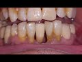 Maryland Bridge. Fixed teeth. Minimal tooth damage