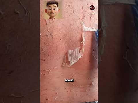 تقشير الجلد يمكن ان يسبب مرضا خطيرا